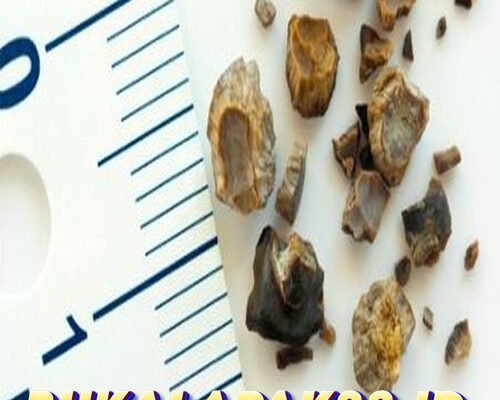 3 Pasien Batu Ginjal Ceritakan Gejala Awal yang Dirasakan, Seperti Ini Rasanya
